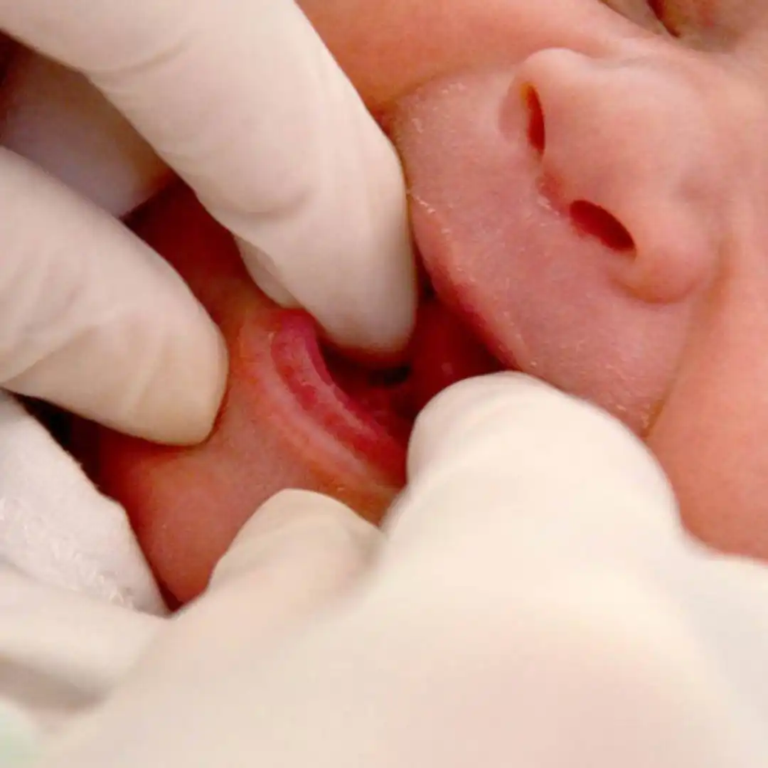 Teste da Linguinha - Fonoaudiologa - Victória Maria - Goiânia - GO